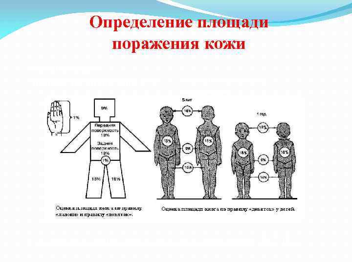 Площадь поражения. Площадь поражения кожи. Оценка площади поражение кожи. Определение площади поражения. Площадь поражения по правилу ладони.