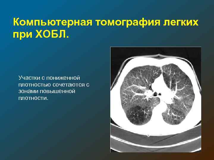 Компьютерная томография легких при ХОБЛ. Участки с пониженной плотностью сочетаются с зонами повышенной плотности.