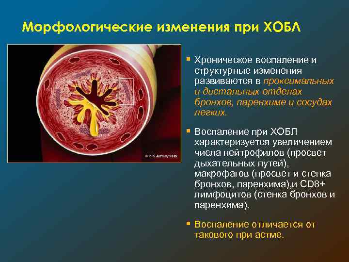 Морфологические изменения при ХОБЛ § Хроническое воспаление и структурные изменения развиваются в проксимальных и