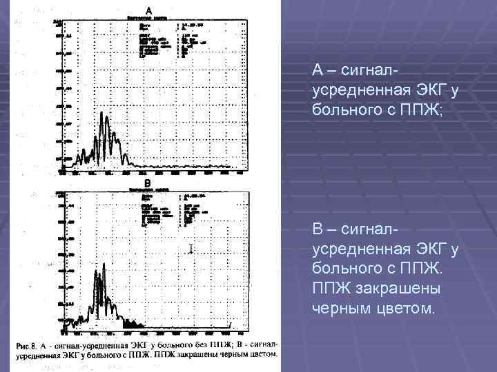 А – сигналусредненная ЭКГ у больного с ППЖ; В – сигналусредненная ЭКГ у больного