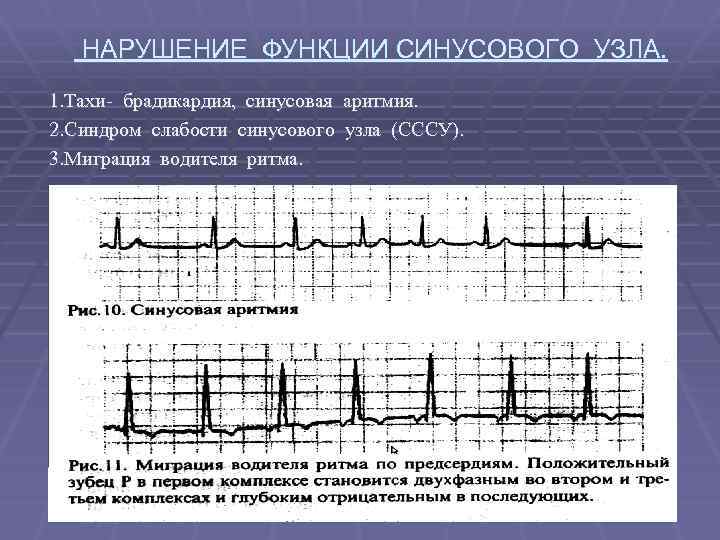  НАРУШЕНИЕ ФУНКЦИИ СИНУСОВОГО УЗЛА. 1. Тахи- брадикардия, синусовая аритмия. 2. Синдром слабости синусового