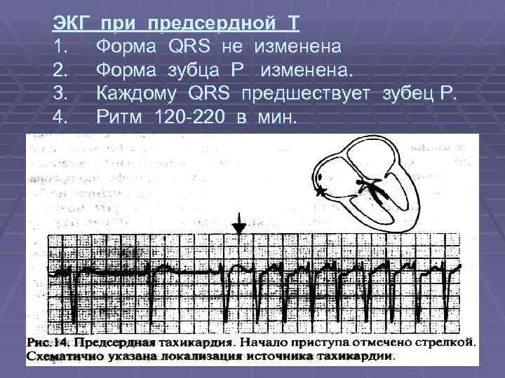 ЭКГ при предсердной Т 1. Форма QRS не изменена 2. Форма зубца Р изменена.