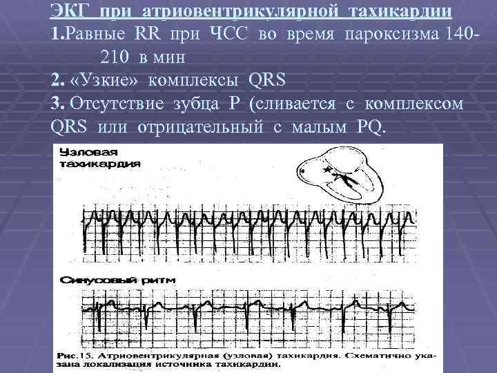 ЭКГ при атриовентрикулярной тахикардии 1. Равные RR при ЧСС во время пароксизма 140 -