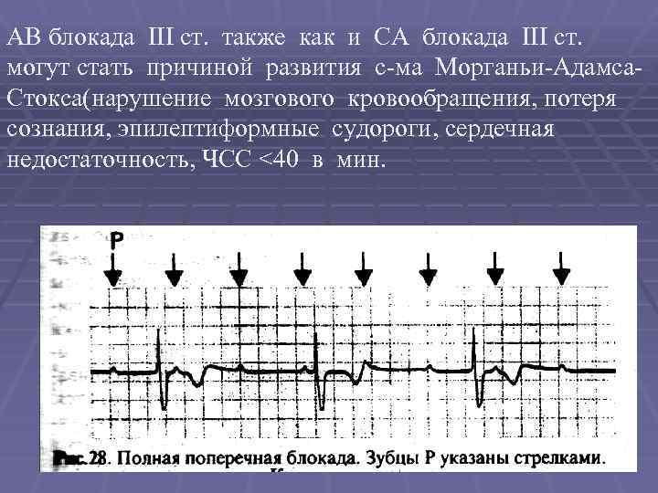 АВ блокада III ст. также как и СА блокада III ст. могут стать причиной