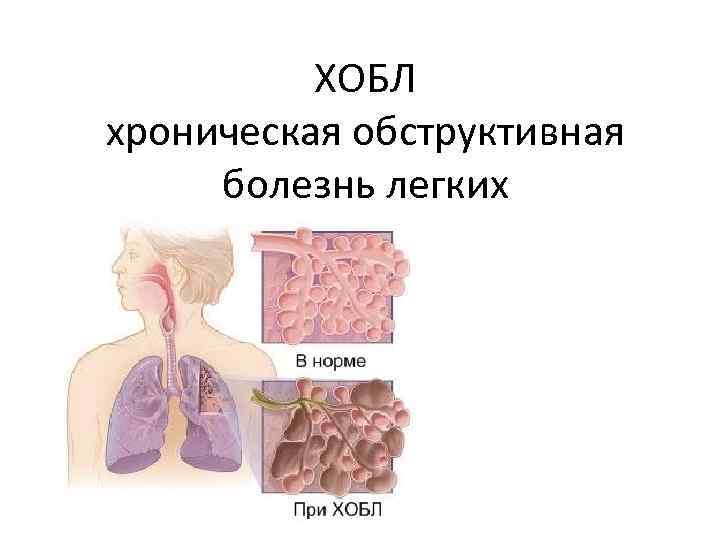 Хроническая обструктивная болезнь легких картинки