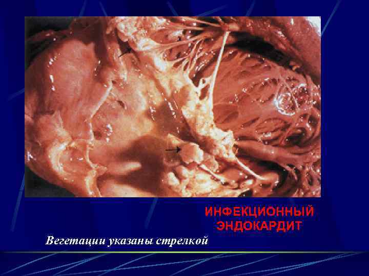 ИНФЕКЦИОННЫЙ ЭНДОКАРДИТ Вегетации указаны стрелкой 