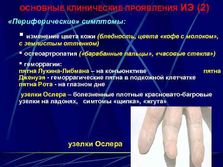 ОСНОВНЫЕ КЛИНИЧЕСКИЕ ПРОЯВЛЕНИЯ ИЭ (2) «Периферические» симптомы: § изменение цвета кожи (бледность, цвета «кофе
