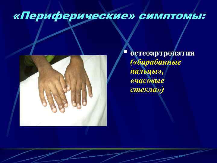  «Периферические» симптомы: § остеоартропатия ( «барабанные пальцы» , «часовые стекла» ) 