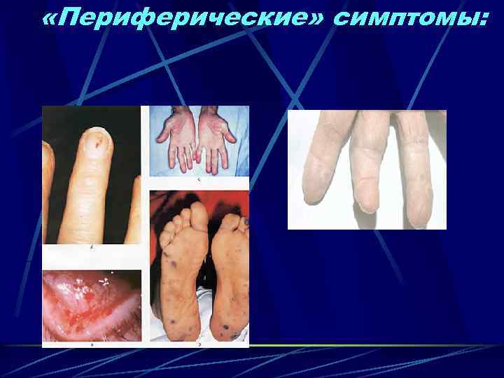  «Периферические» симптомы: 