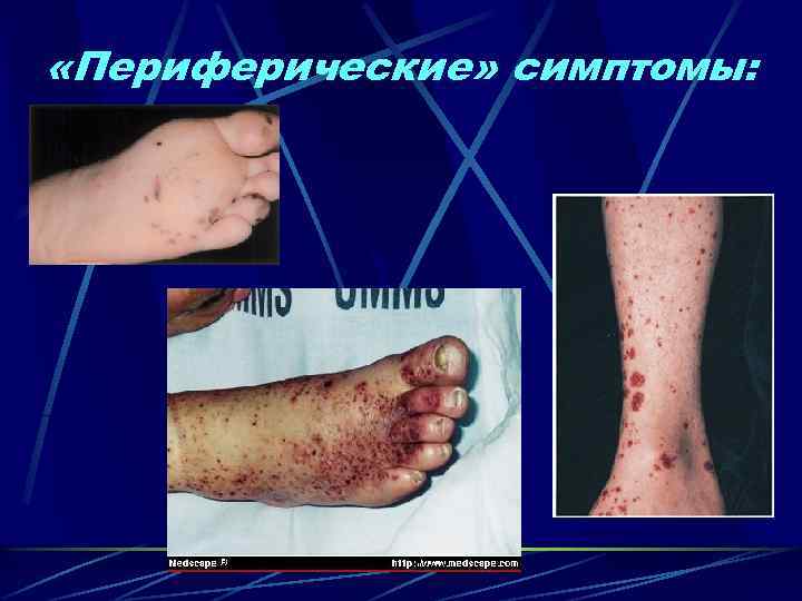  «Периферические» симптомы: 