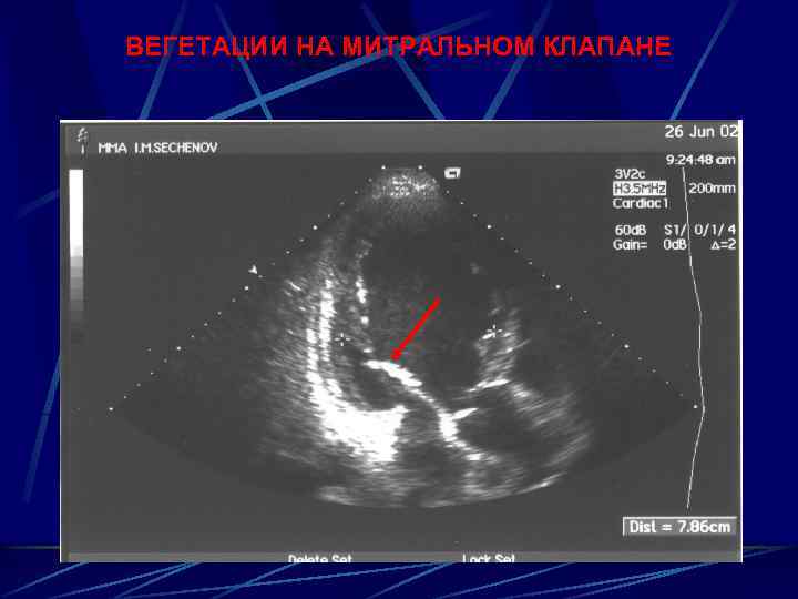ВЕГЕТАЦИИ НА МИТРАЛЬНОМ КЛАПАНЕ 