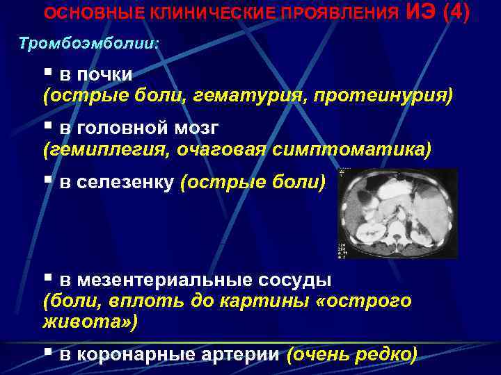 ОСНОВНЫЕ КЛИНИЧЕСКИЕ ПРОЯВЛЕНИЯ ИЭ (4) Тромбоэмболии: § в почки (острые боли, гематурия, протеинурия) §