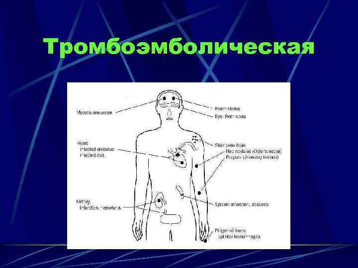 Тромбоэмболическая 