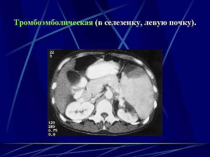 Тромбоэмболическая (в селезенку, левую почку). 