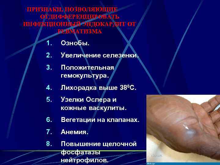 ПРИЗНАКИ, ПОЗВОЛЯЮЩИЕ ОТДИФФЕРЕНЦИРОВАТЬ ИНФЕКЦИОННЫЙ ЭНДОКАРДИТ ОТ РЕВМАТИЗМА 1. Ознобы. 2. Увеличение селезенки. 3. Положительная