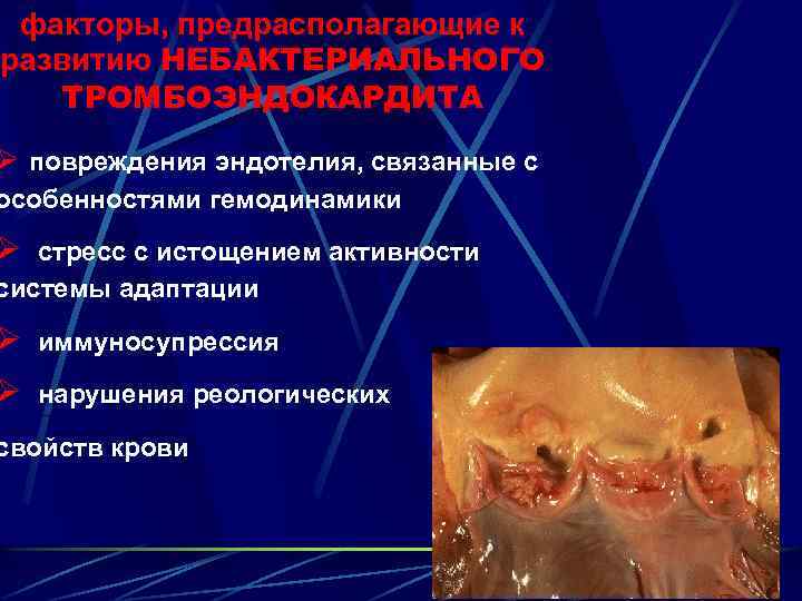 факторы, предрасполагающие к развитию НЕБАКТЕРИАЛЬНОГО ТРОМБОЭНДОКАРДИТА Ø повреждения эндотелия, связанные с особенностями гемодинамики Ø