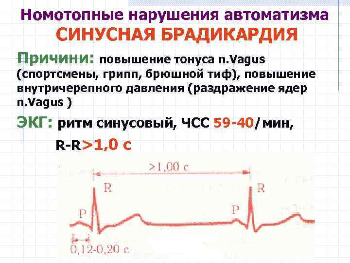 Номотопные нарушения автоматизма СИНУСНАЯ БРАДИКАРДИЯ Причини: повышение тонуса n. Vagus (спортсмены, грипп, брюшной тиф),