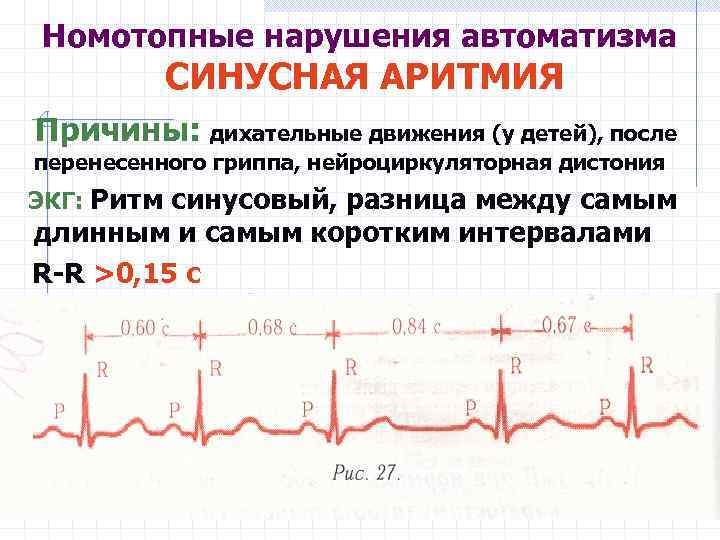 Номотопные нарушения автоматизма СИНУСНАЯ АРИТМИЯ Причины: дихательные движения (у детей), после перенесенного гриппа, нейроциркуляторная