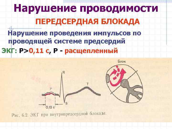 Нарушение проводимости ПЕРЕДСЕРДНАЯ БЛОКАДА Нарушение проведения импульсов по проводящей системе предсердий ЭКГ: Р>0, 11