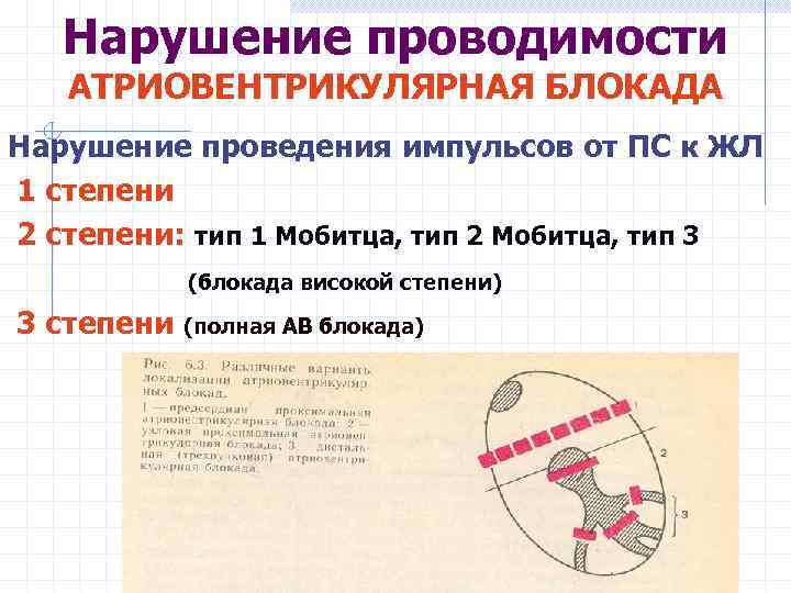 Нарушение проводимости АТРИОВЕНТРИКУЛЯРНАЯ БЛОКАДА Нарушение проведения импульсов от ПС к ЖЛ 1 степени 2