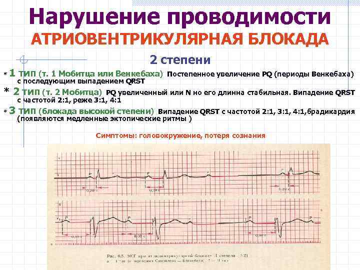 Нарушение проводимости АТРИОВЕНТРИКУЛЯРНАЯ БЛОКАДА 2 степени * 1 тип (т. 1 Мобитца или Венкебаха)