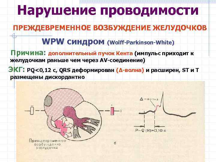 Нарушение проводимости ПРЕЖДЕВРЕМЕННОЕ ВОЗБУЖДЕНИЕ ЖЕЛУДОЧКОВ WPW синдром (Wolff-Parkinson-White) Причина: дополнительный пучок Кента (импульс приходит