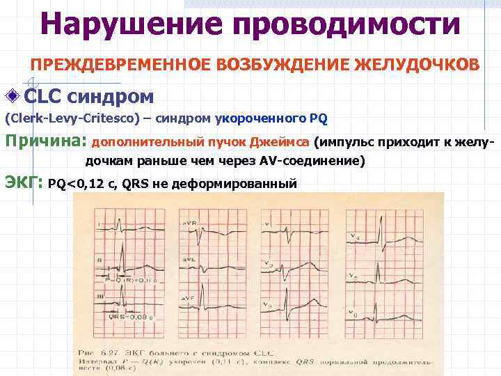 Нарушение проводимости ПРЕЖДЕВРЕМЕННОЕ ВОЗБУЖДЕНИЕ ЖЕЛУДОЧКОВ CLC синдром (Clerk-Levy-Critesco) – синдром укороченного PQ Причина: дополнительный