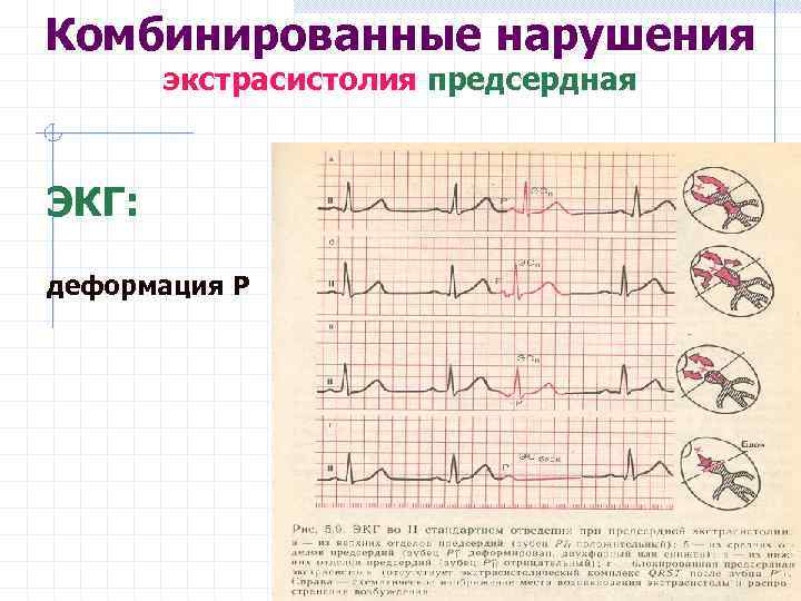 Комбинированные нарушения экстрасистолия предсердная ЭКГ: деформация Р 