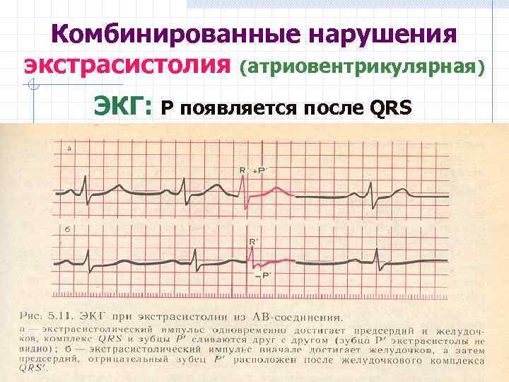 Комбинированные нарушения экстрасистолия (атриовентрикулярная) ЭКГ: Р появляется после QRS 