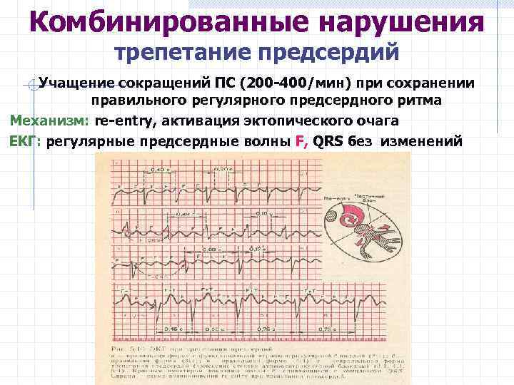 Комбинированные нарушения трепетание предсердий Учащение сокращений ПС (200 -400/мин) при сохранении правильного регулярного предсердного