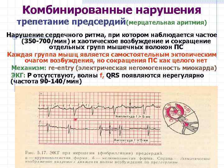 Комбинированные нарушения трепетание предсердий(мерцательная аритмия) Нарушение сердечного ритма, при котором наблюдается частое (350 -700/мин)