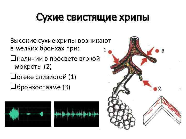 Сухие свистящие хрипы Высокие сухие хрипы возникают в мелких бронхах при: qналичии в просвете