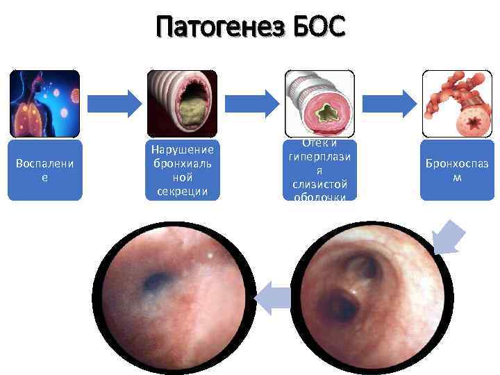 Патогенез БОС Воспалени е Нарушение бронхиаль ной секреции Отек и гиперплази я слизистой оболочки