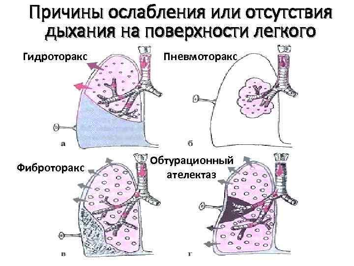 Причины ослабления или отсутствия дыхания на поверхности легкого Гидроторакс Пневмоторакс Фиброторакс Обтурационный ателектаз 