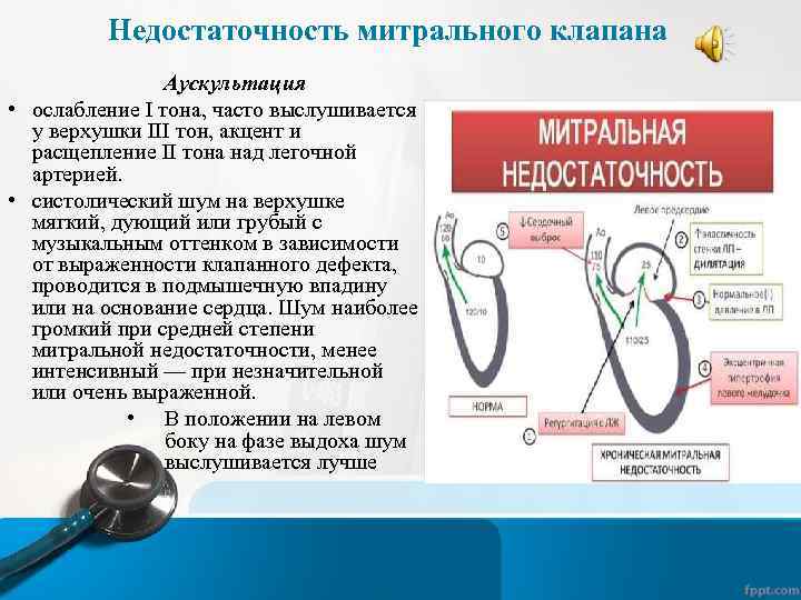 Недостаточность митрального клапана Аускультация • ослабление I тона, часто выслушивается у верхушки III тон,