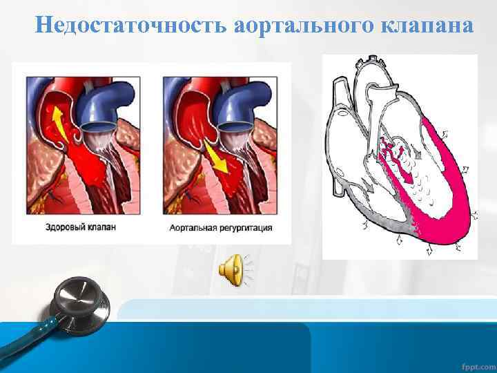 Фиброзные изменения аортального клапана