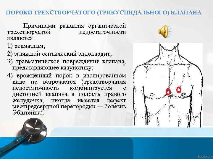 ПОРОКИ ТРЕХСТВОРЧАТОГО (ТРИКУСПИДАЛЬНОГО) КЛАПАНА Причинами развития органической трехстворчатой недостаточности являются: 1) ревматизм; 2) затяжной