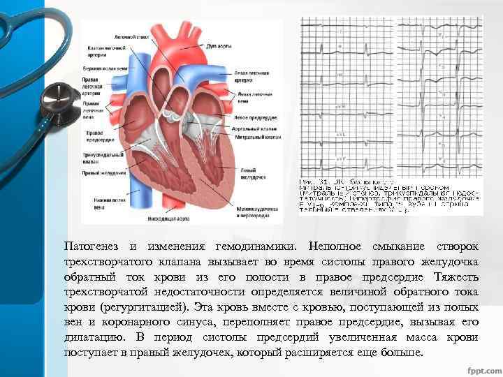 Патогенез и изменения гемодинамики. Неполное смыкание створок трехстворчатого клапана вызывает во время систолы правого