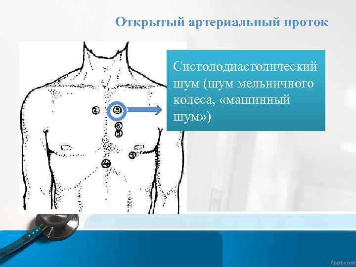 Точка выслушивания митрального клапана