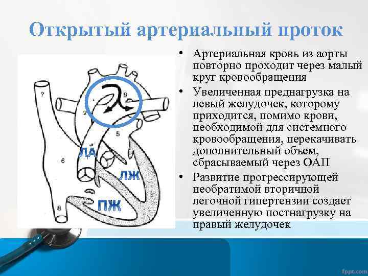 Открытый артериальный проток • Артериальная кровь из аорты повторно проходит через малый круг кровообращения