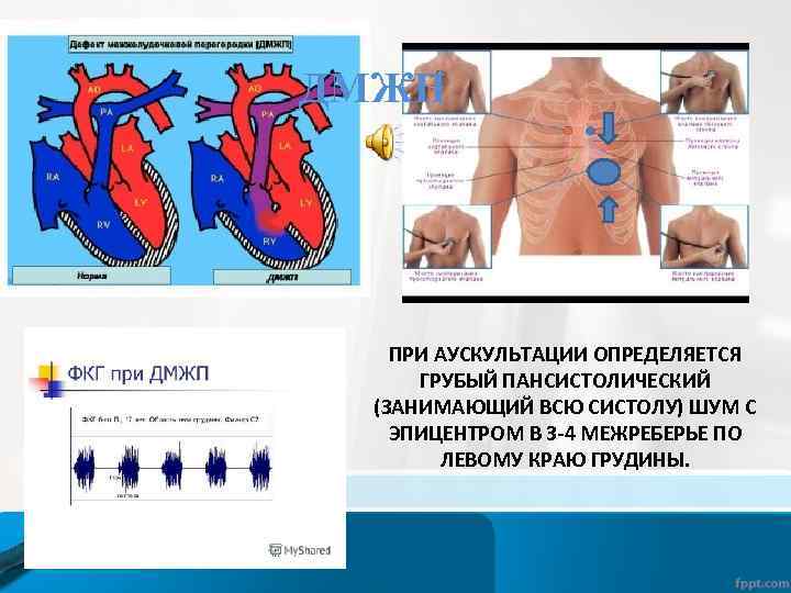 Клапаны сердца схема аускультации