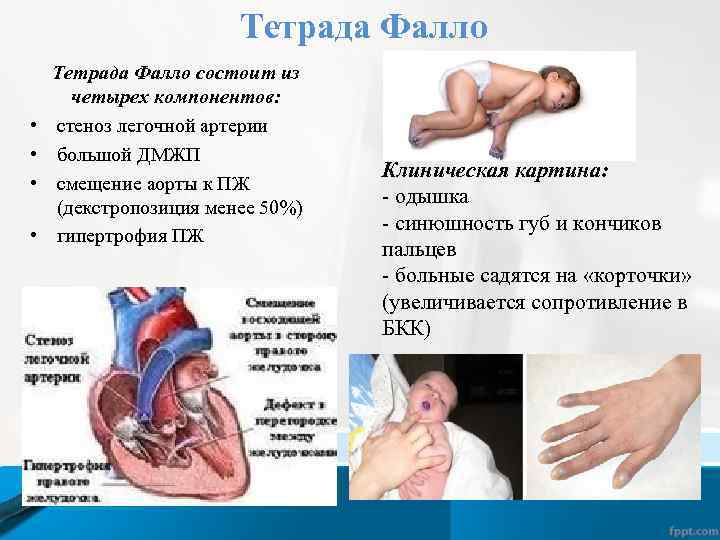 Дисфункция клапана легочной артерии