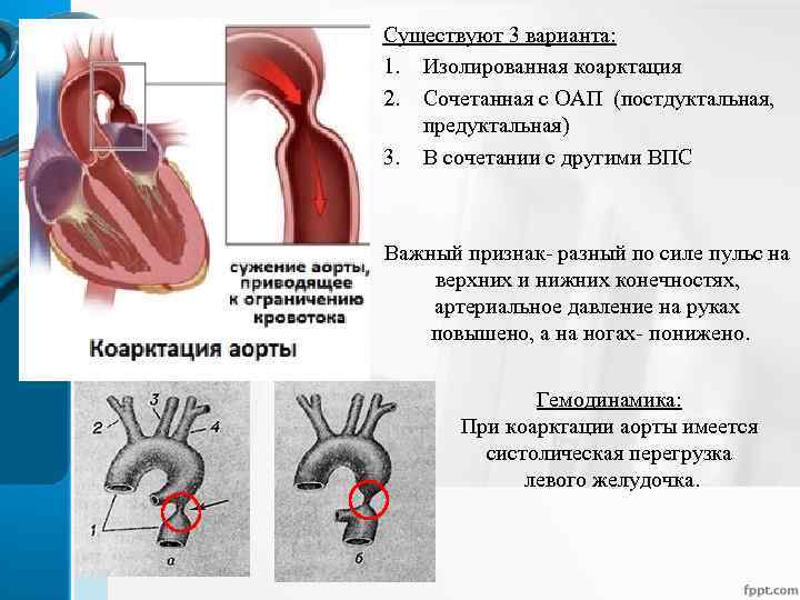 Существуют 3 варианта: 1. Изолированная коарктация 2. Сочетанная с ОАП (постдуктальная, предуктальная) 3. В