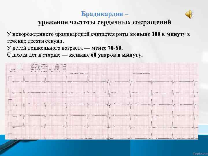 Брадикардия – урежение частоты сердечных сокращений У новорожденного брадикардией считается ритм меньше 100 в