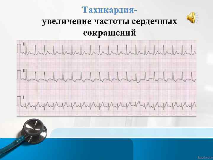 Тахикардияувеличение частоты сердечных сокращений 