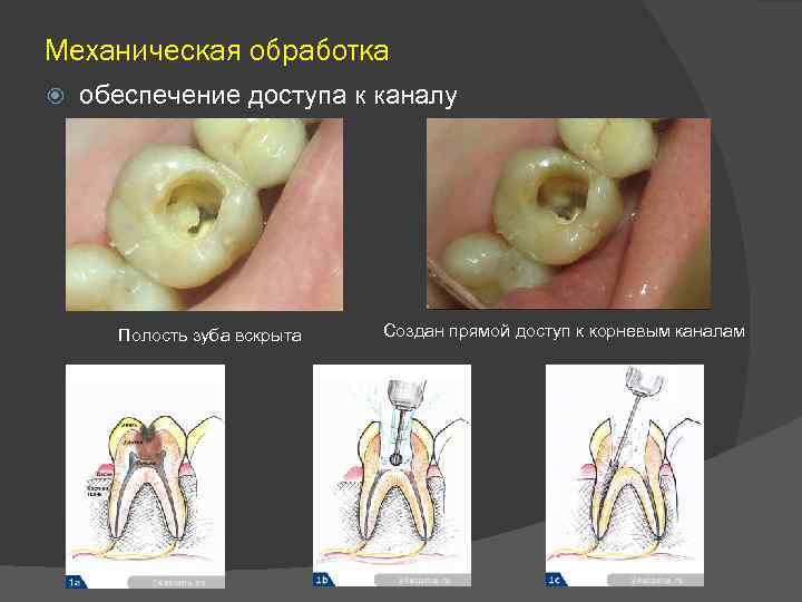 Механическая обработка обеспечение доступа к каналу Полость зуба вскрыта Создан прямой доступ к корневым