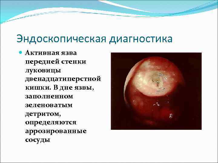 Эндоскопическая диагностика Активная язва передней стенки луковицы двенадцатиперстной кишки. В дне язвы, заполненном зеленоватым