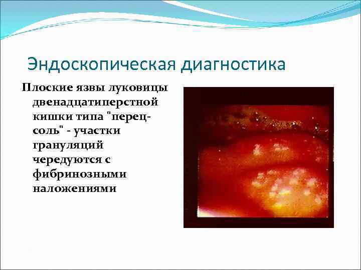 Эндоскопическая диагностика Плоские язвы луковицы двенадцатиперстной кишки типа "перецсоль" - участки грануляций чередуются с