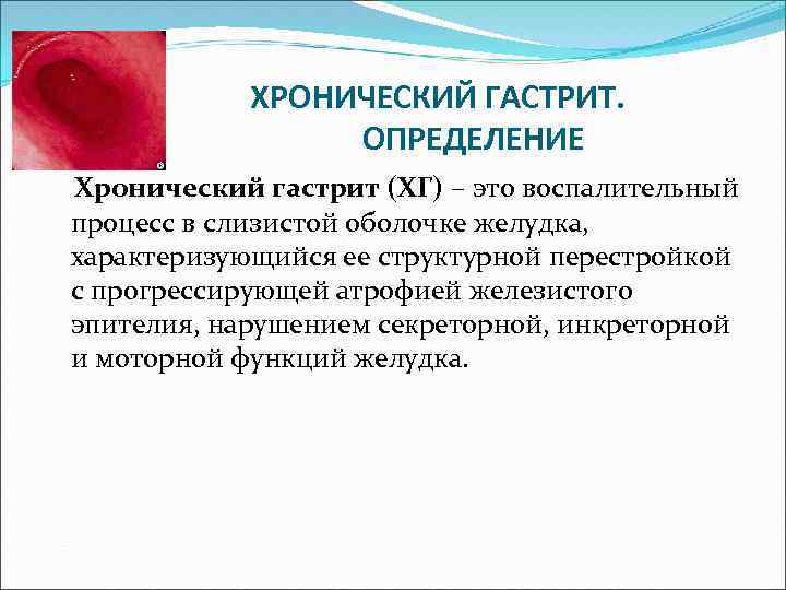 ХРОНИЧЕСКИЙ ГАСТРИТ. ОПРЕДЕЛЕНИЕ Хронический гастрит (ХГ) – это воспалительный процесс в слизистой оболочке желудка,