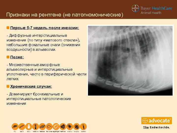 Признаки на рентгене (не патогномонические) Первые 5 -7 недель после инвазии: - Диффузные интерстициальные